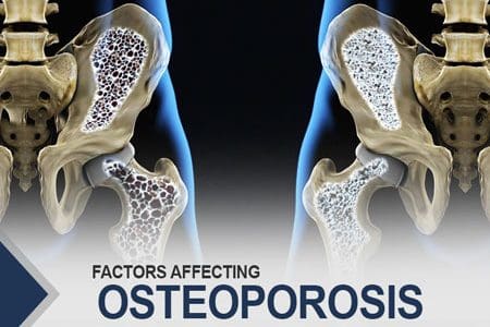 Factors Affecting Osteoporosis